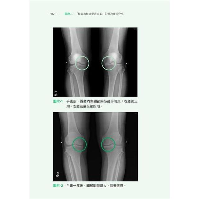 自己的膝蓋自己救:退化性膝關節炎的真相【暢銷增訂版】 自己的膝蓋自己救:退化性膝關節炎的真相【暢銷增訂版】
