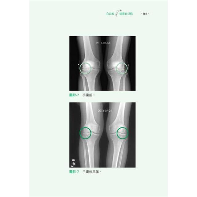 自己的膝蓋自己救:退化性膝關節炎的真相【暢銷增訂版】 自己的膝蓋自己救:退化性膝關節炎的真相【暢銷增訂版】