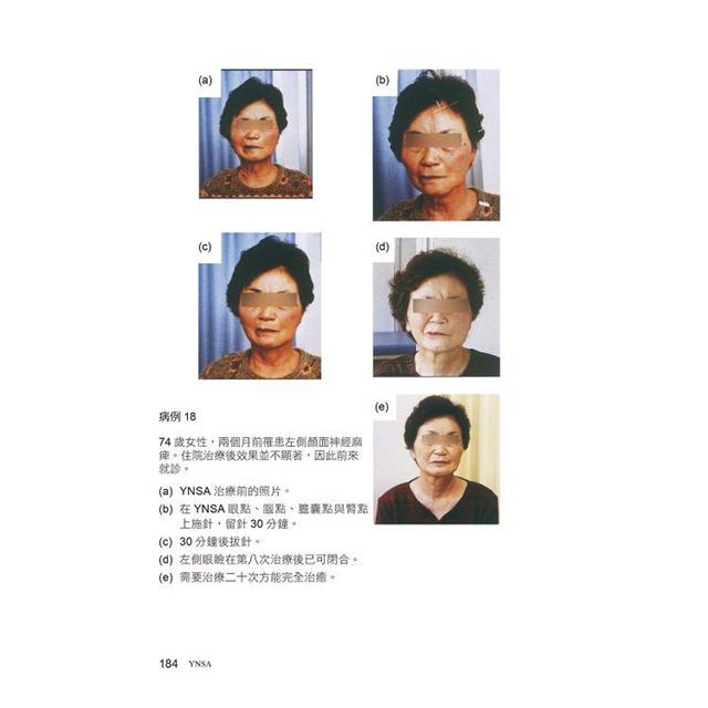 YNSA山元式新頭針療法：真人圖解刺激點施針教科書！－金石堂