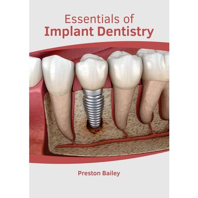 Essentials of Implant Dentistry