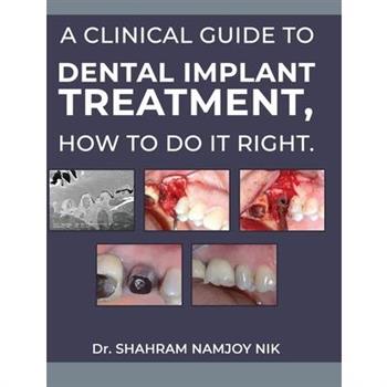 A guide to dental implant treatment, how to do it right.