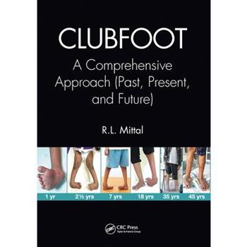 Clubfoot