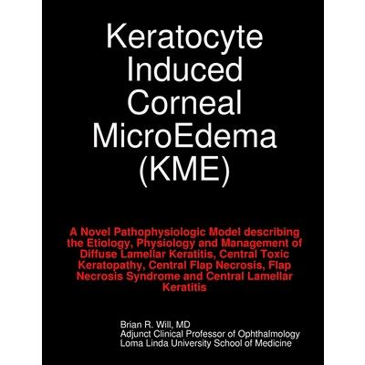 Keratocyte Induced Corneal MicroEdema