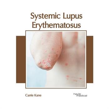 Systemic Lupus Erythematosus