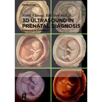 3D Ultrasound in Prenatal Diagnosis