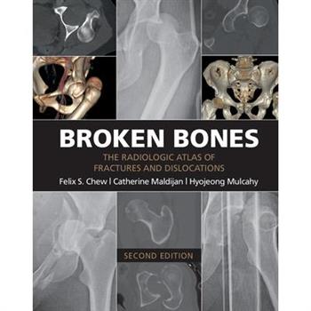 Broken Bones
